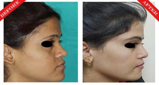 rhinoplasty surgery