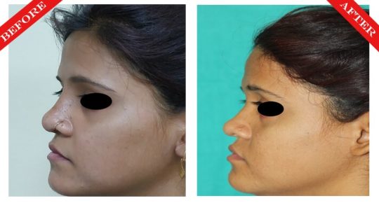 rhinoplasty surgery