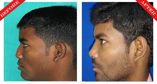 rhinoplasty surgery