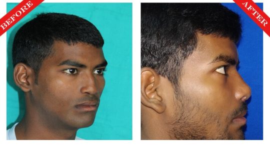 rhinoplasty surgery